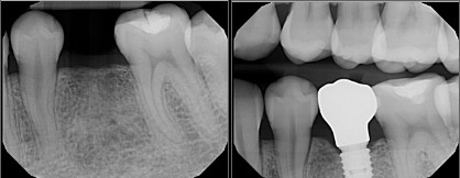 Dental Implants